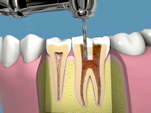 Endodonzia | Devitalizzazione| Granuloma