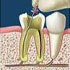 Endodonzia | Devitalizzazione| Granuloma